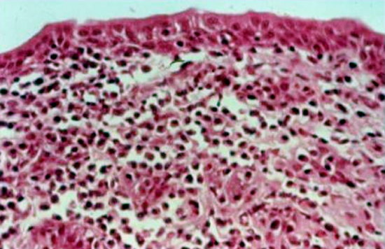 Mycoplasma gallisepticum